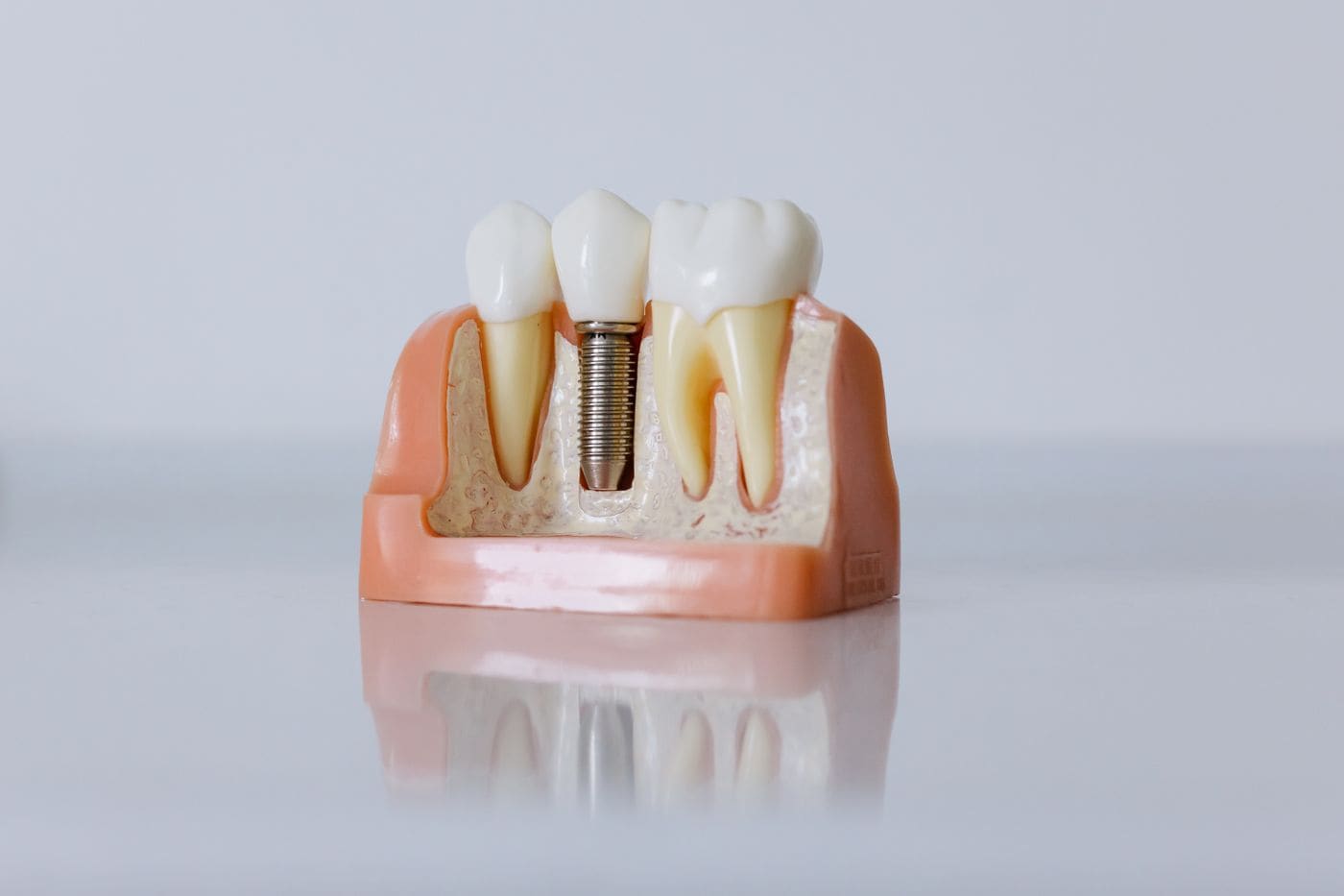 Diş implantını kesitte gösteren anatomik model